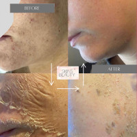 GREEN SEA PEEL. Срединный пилинг с микроиглами для всех типов кожи: омоложение, лечение акне, отбеливание. Набор (1 гр + 5 мл)