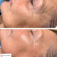 V TOX LIFT MASK. Ультраактивна маска для безін'єкційного ниткового ліфтингу з 11-ма Пептидами та 6-ма видами Колагену. Інноваційна рідка формула з трансформацією на шкірі: висихання, глянцевий каркас, сильний ліфтинговий натяг, 100 мл